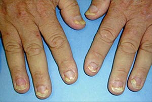 Onycholyse: der Nagel löst sich vom Nagelbett; dies ist bei Psoriasis nicht ungewöhnlich.