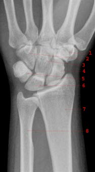 Gesundes rechtes Handgelenk von palmar: 1. Os trapezium, 2. Os hamatum, 3. Os capitatum, 4. Os scaphoideum, 5. Os triquetrum, 6. Os lunatum, 7. Radius, 8. Ulna