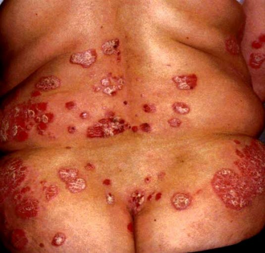 Ausgeprägt Psoriasis vulgaris