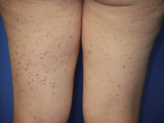Klinische Diagnose Typisch sind Purpura, Bauchschmerzen, Arthritis und Befund einer Nierenerkrankung bei gleichzeitigem Fehlen einer Thrombozytopenie. Klinische Diagnose Typisch sind Purpura, Bauchschmerzen, Arthritis und Befund einer Nierenerkrankung bei gleichzeitigem Fehlen einer Thrombozytopenie.