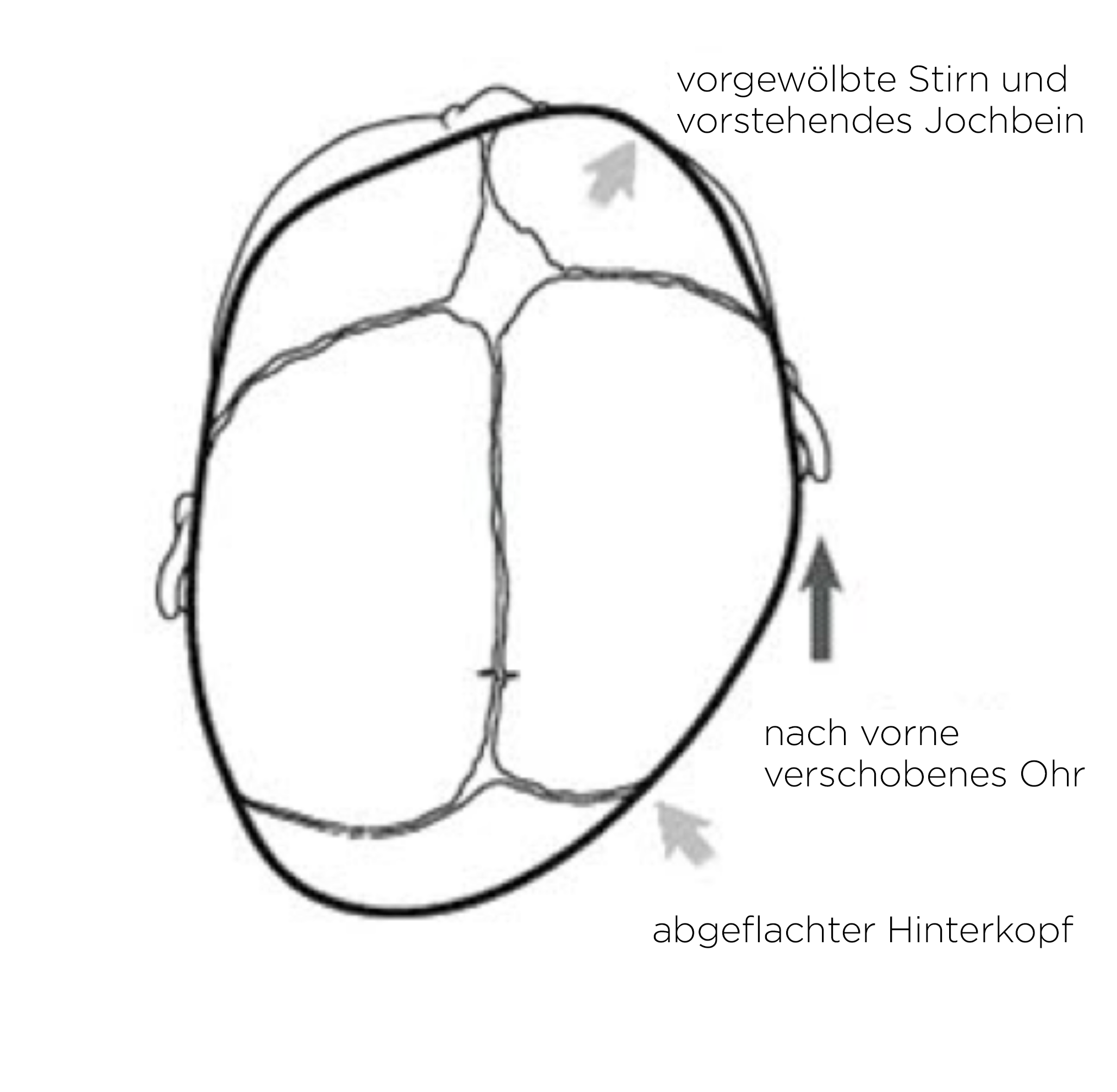 Plagiozephalie
