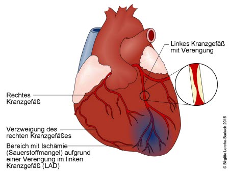 Durch eine Verengung des Herzkranzgefäßes durch Arteriosklerose (Arterienverkalkung) kommt es zu einer Unterversorgung des Herzmuskels mit Sauerstoff