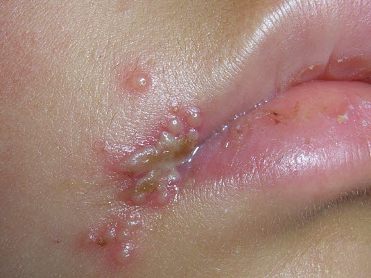 Herpes labialis