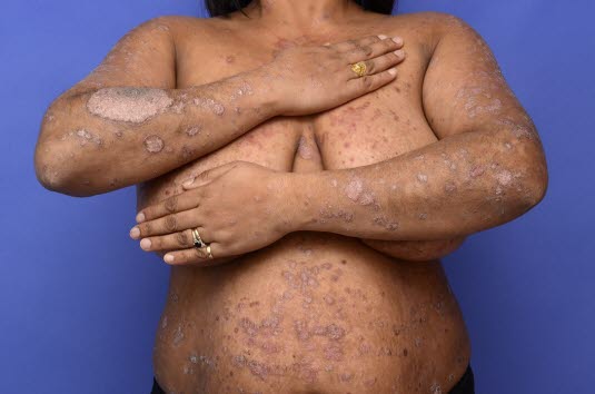 Ausgeprägte Psoriasis vulgaris