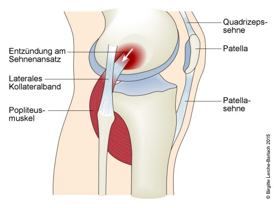 Popliteus-Tendinopathie