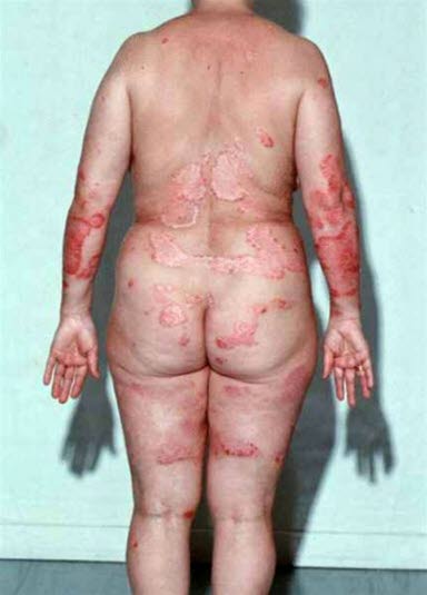 Ausgeprägte Psoriasis vulgaris