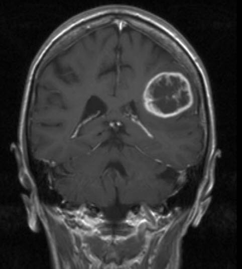 Glioblastom WHO Grad IV 1