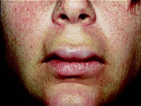 Angioödem der Lippe. Angioödeme sind oft akut auftretende und klar abgegrenzte Hautödeme im elastischen Gewebe (z.B. Lippe, Augenlid, Ohrläppchen, Zunge und Gaumenzäpfchen).