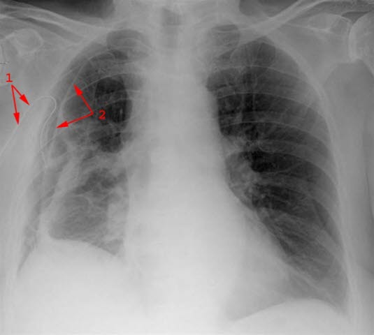 Pneumothorax mit Drainage (1) im Pleuraraum. Die Pleura visceralis (2) wird sichtbar, wenn Luft zwischen die beiden Pleurablätter gelangt.