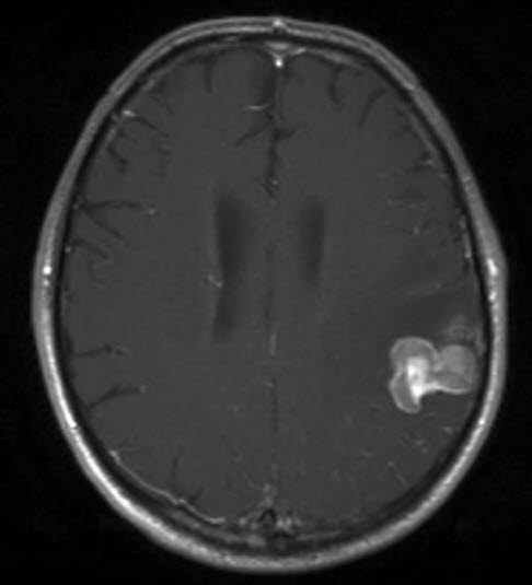 Hirnmetastase durch Nierenkrebs