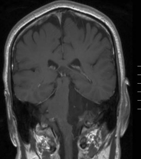 Epidermoidtumor 1