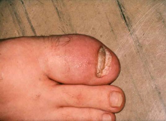 Psoriasis-Arthritis mit Daktylitis 