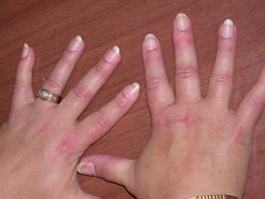 Dermatomyositis: Nagelwurzelveränderungen mit u. a. periungualen Teleangiektasien.
