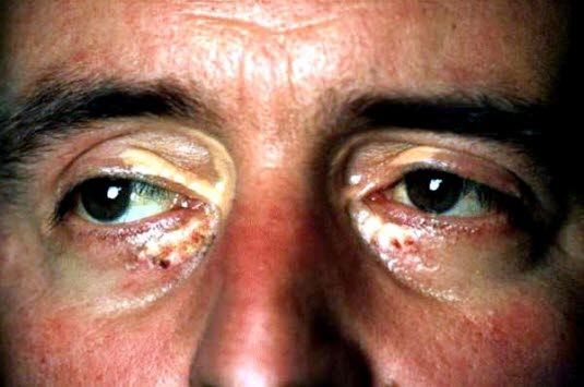 Die Konsistenz eines Xanthelasma palpebrarum kann weich bis hart sein. Es tritt häufig symmetrisch im Bereich der Augenlider meistens nasal auf. Die Konsistenz eines Xanthelasma palpebrarum kann weich bis hart sein. Es tritt häufig symmetrisch im Bereich der Augenlider meistens nasal auf.