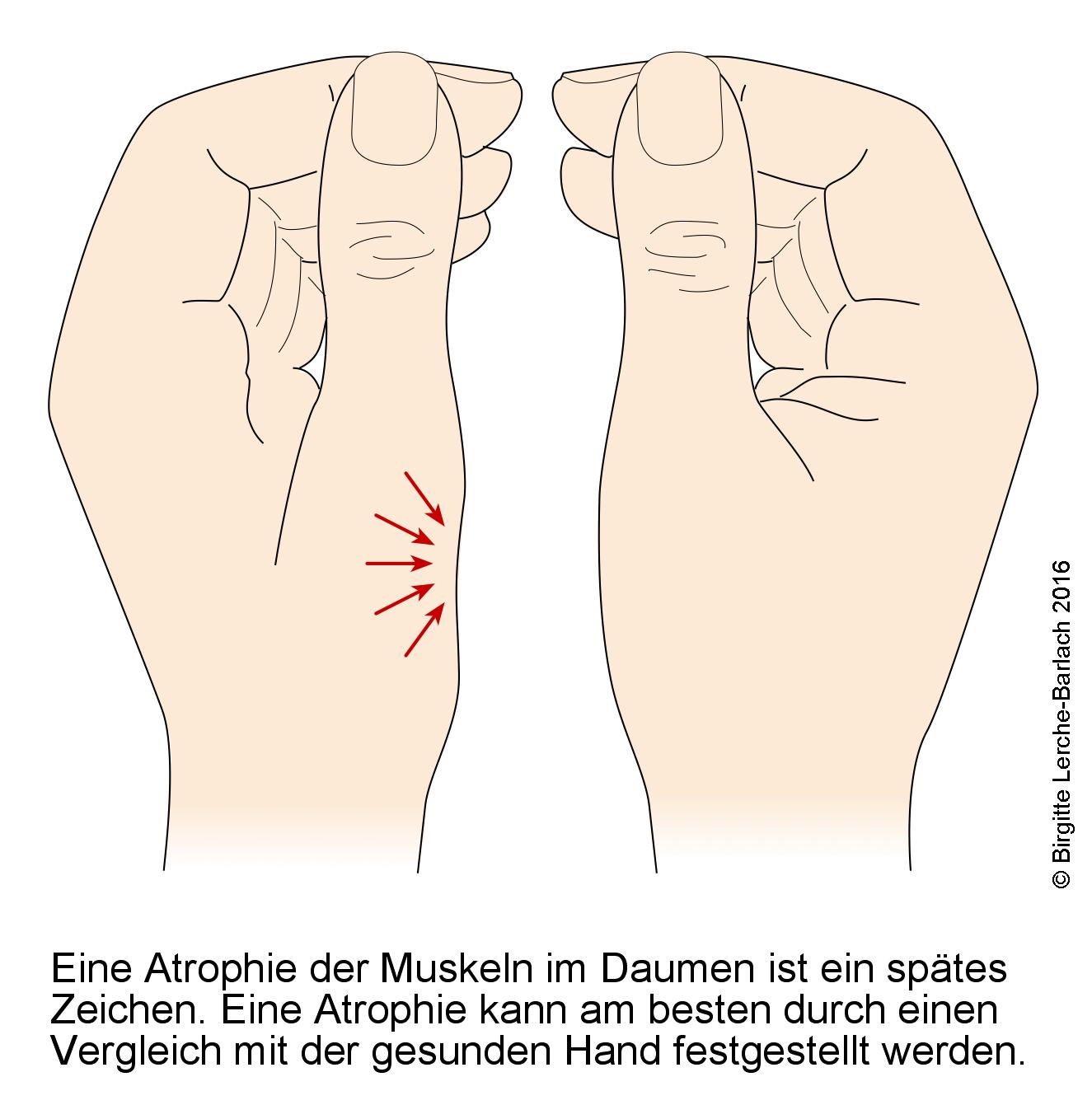 Muskelatrophie der Thenarmuskulatur
