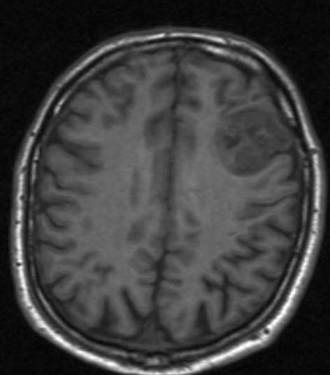Oligodendrogliom 1