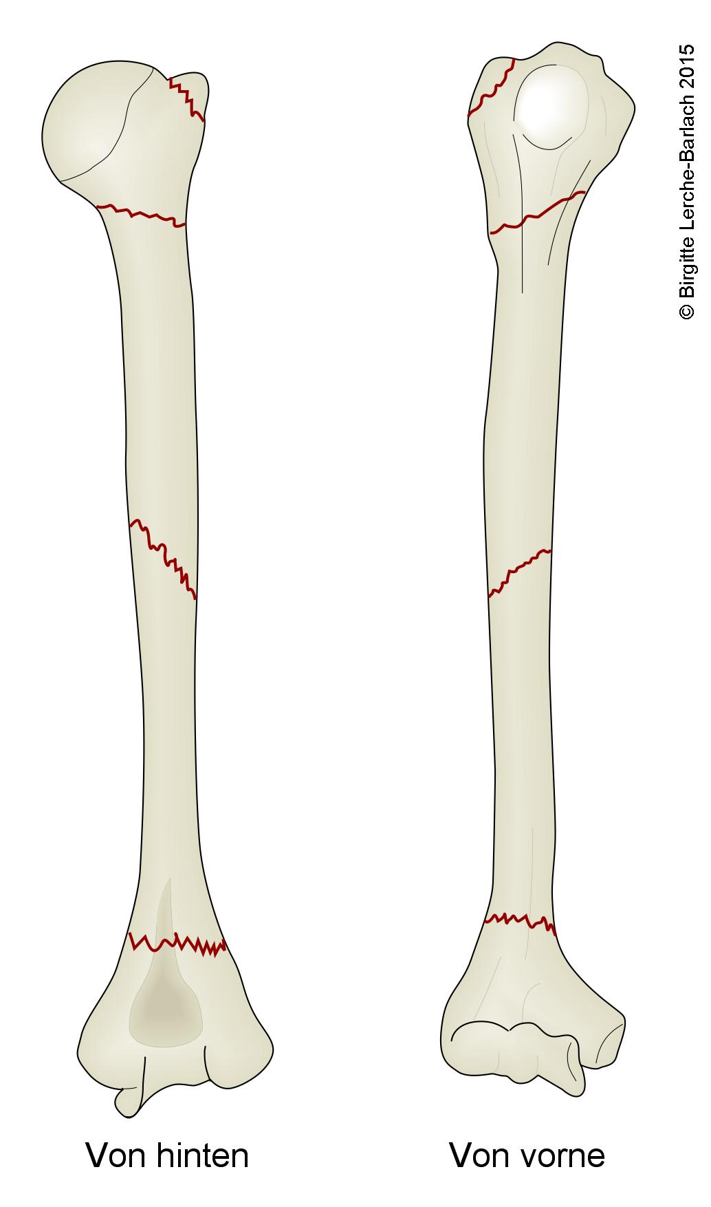 Humerus, häufigste Bruchstellen