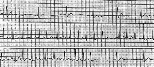 Beispiel von EKG-Veränderungen beim Sick-Sinus-Syndrom