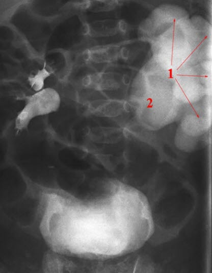 Abgangsstenose (Urografie)