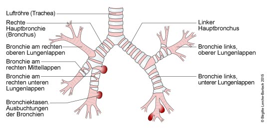Bronchiektasen Bronchiektasen