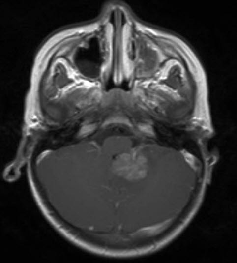 atypischer teratoider/rhabdoider Tumor 1