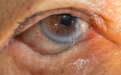 Ektropium temporal, Entropium nasal, Pterygium (Flügelfell) und Arcus senilis cornea. Letztgenanntes tritt häufig im höheren Lebensalter auf und ist ohne Krankheitswert. Ektropion